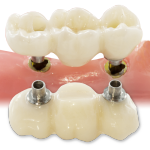 Bruxzir Implant Bridge